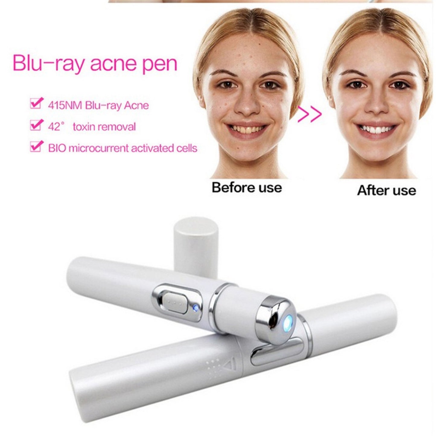 Blue Light Therapy Acne Laser